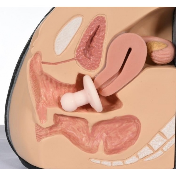 Inel Pessar tip Gellhorn - cu dren