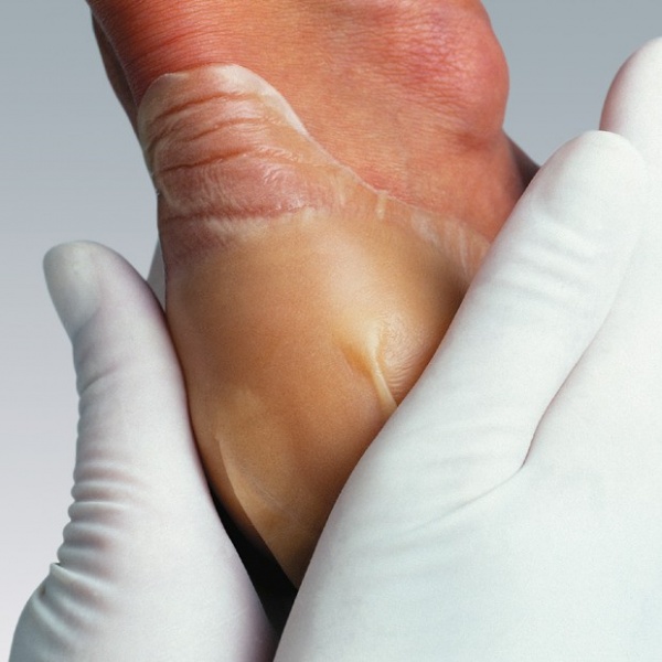 Hydrocoll Classic - Pansament cu hidrocoloid - 15 x 15 cm - 5 buc